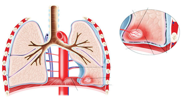 صورة توضيحية لجلطات الرئة